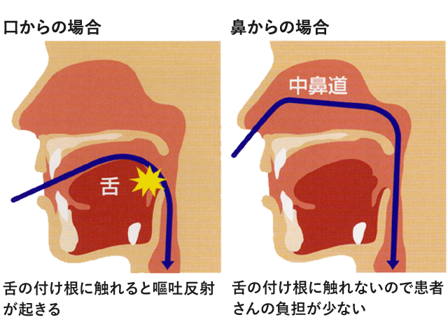 経鼻内視鏡